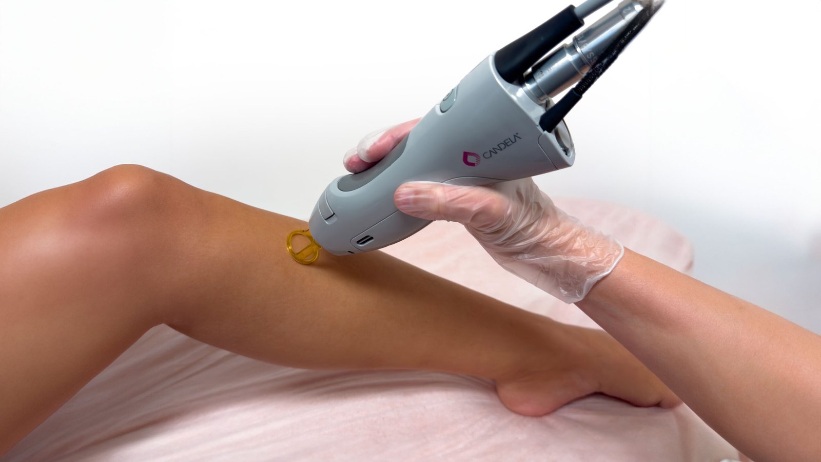 Laser-Haarentfernung am Bein mit dem Candela GentleLase Pro
