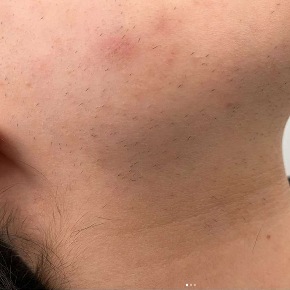 Behandlungsbeispiel Laser-Haarentfernung an Kinn und Hals