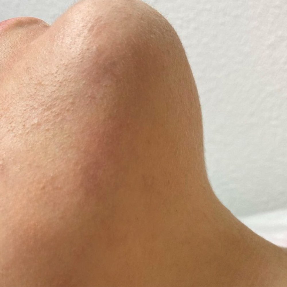 Behandlungsbeispiel Laser-Haarentfernung am Hals