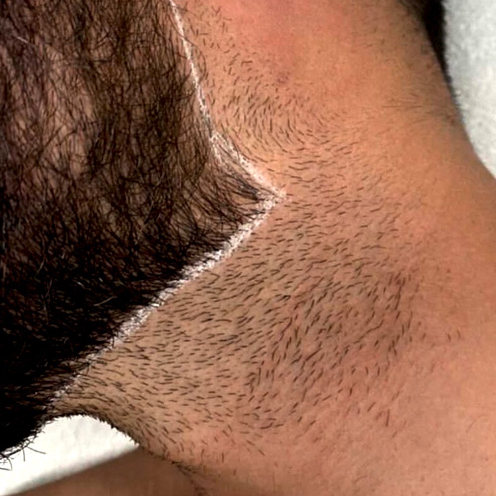 Behandlungsbeispiel Laser-Haarentfernung für Männer
